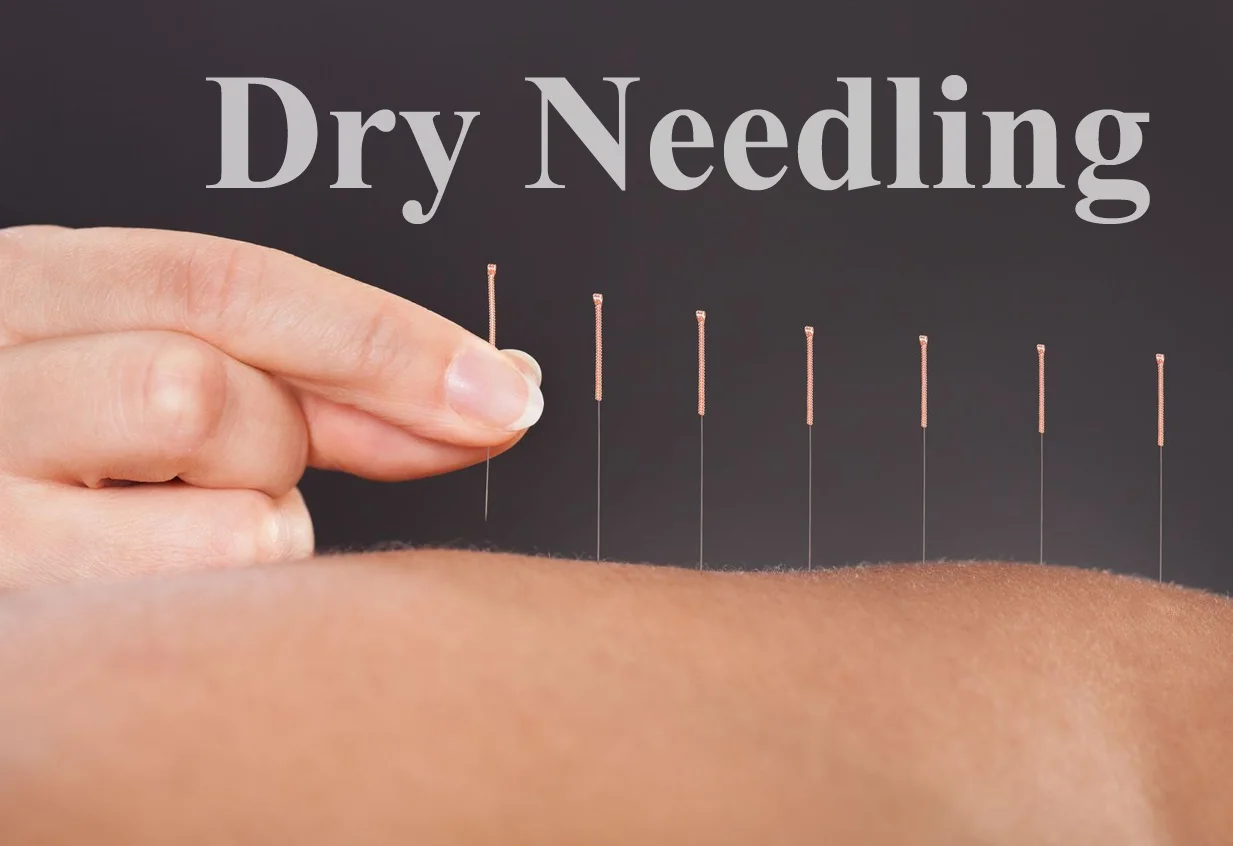 Dry Needling